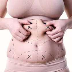 Liposuction treatment illustration