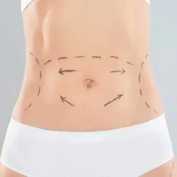 Tummy tuck treatment illustration